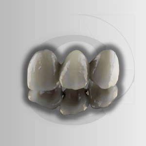 Veneers in Lithium Disilicate