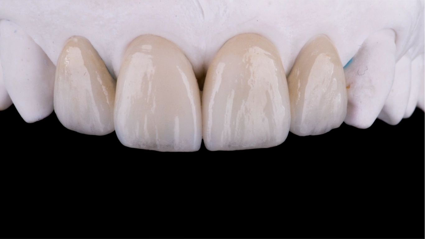 Veneers